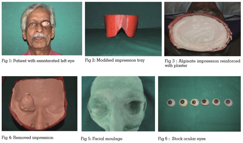 Impression for facial moulage